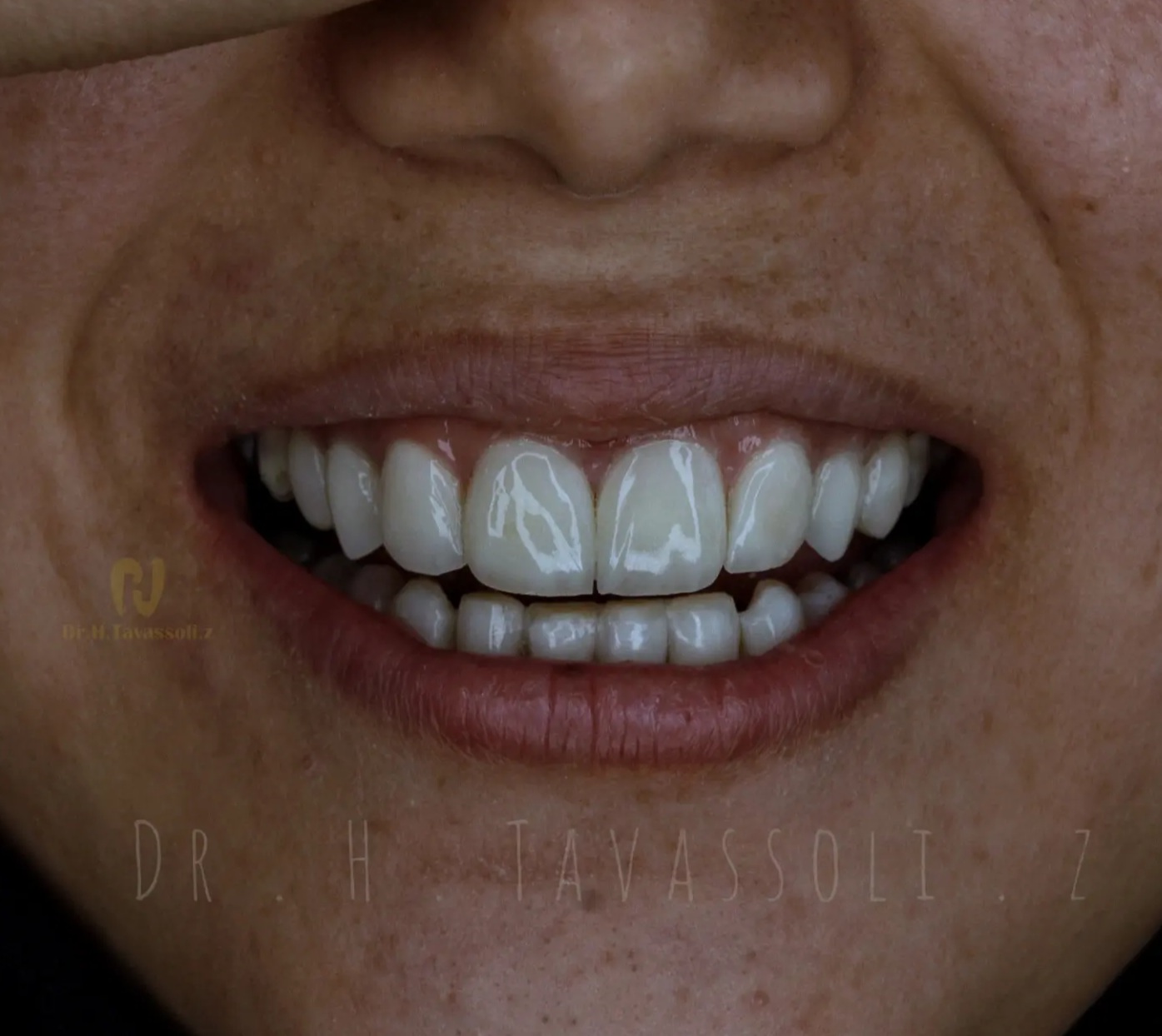 کامپوزیت ونیر ips و طراحی لبخند با لمینیت سرامیکی