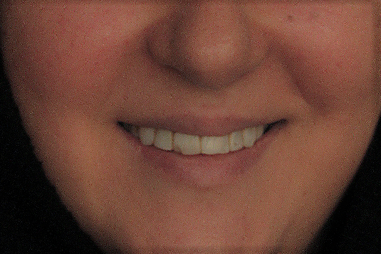 دندان های نامرتب و نازیبا ، نیاز به کامپوزیت ونیر و لمینیت سرامیکی ، نیاز به ارتودنسی