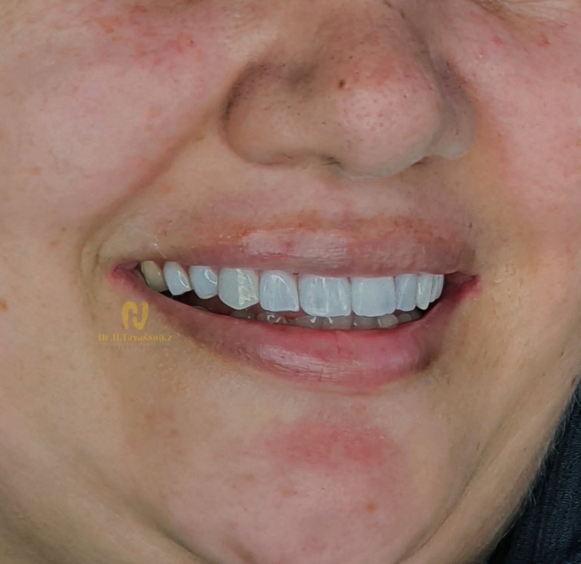 کامپوزیت ونیر ips و طراحی لبخند با لمینیت سرامیکی