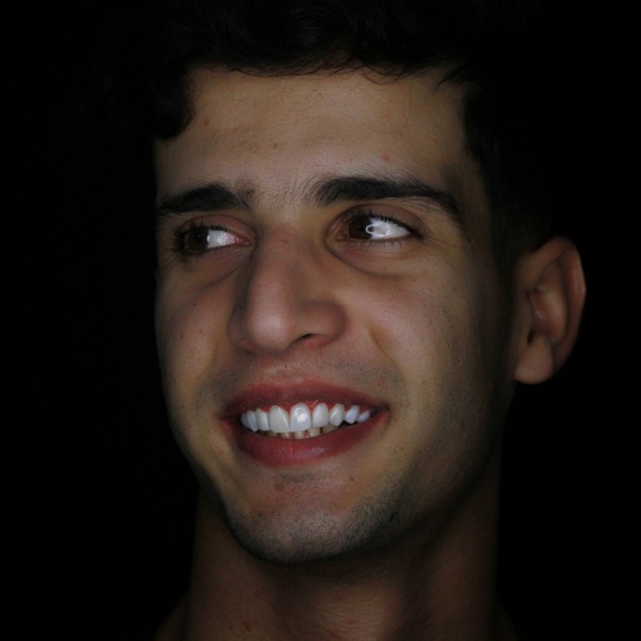 کامپوزیت ونیر Ips و طراحی لبخند و لمینیت دندان