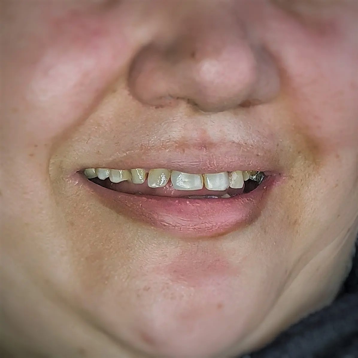 عکس قبل از درمان کامپوزیت ونیر و جراحی لثه