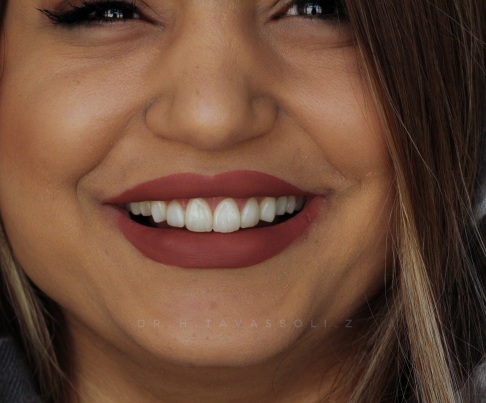 طراحی لبخند و کامپوزیت ونیر Ips و لمینیت