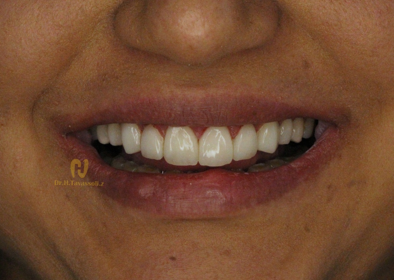 کامپوزیت ونیر ips و طراحی لبخند با لمینیت سرامیکی