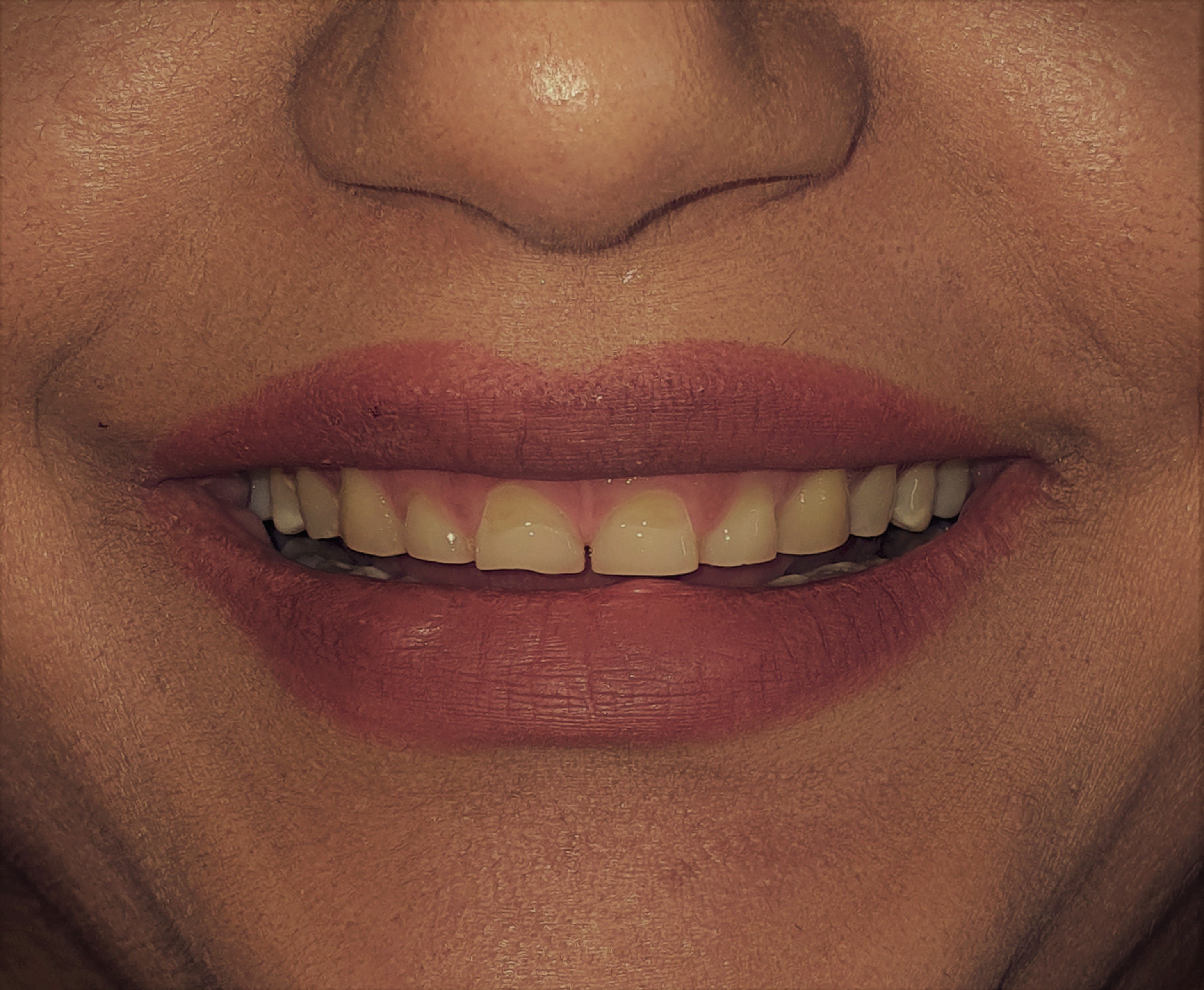عکس قبل از درمان کامپوزیت ونیر و جراحی لثه