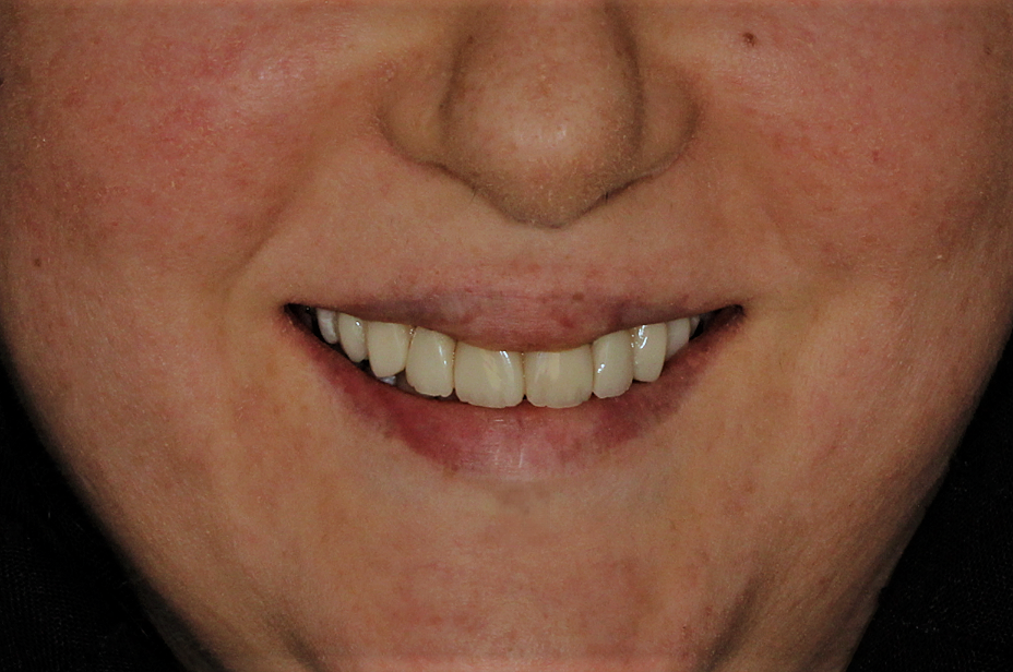 طراحی لبخند با کامپوزیت ونیر ips و سوییسی ، لمینیت ایمکس